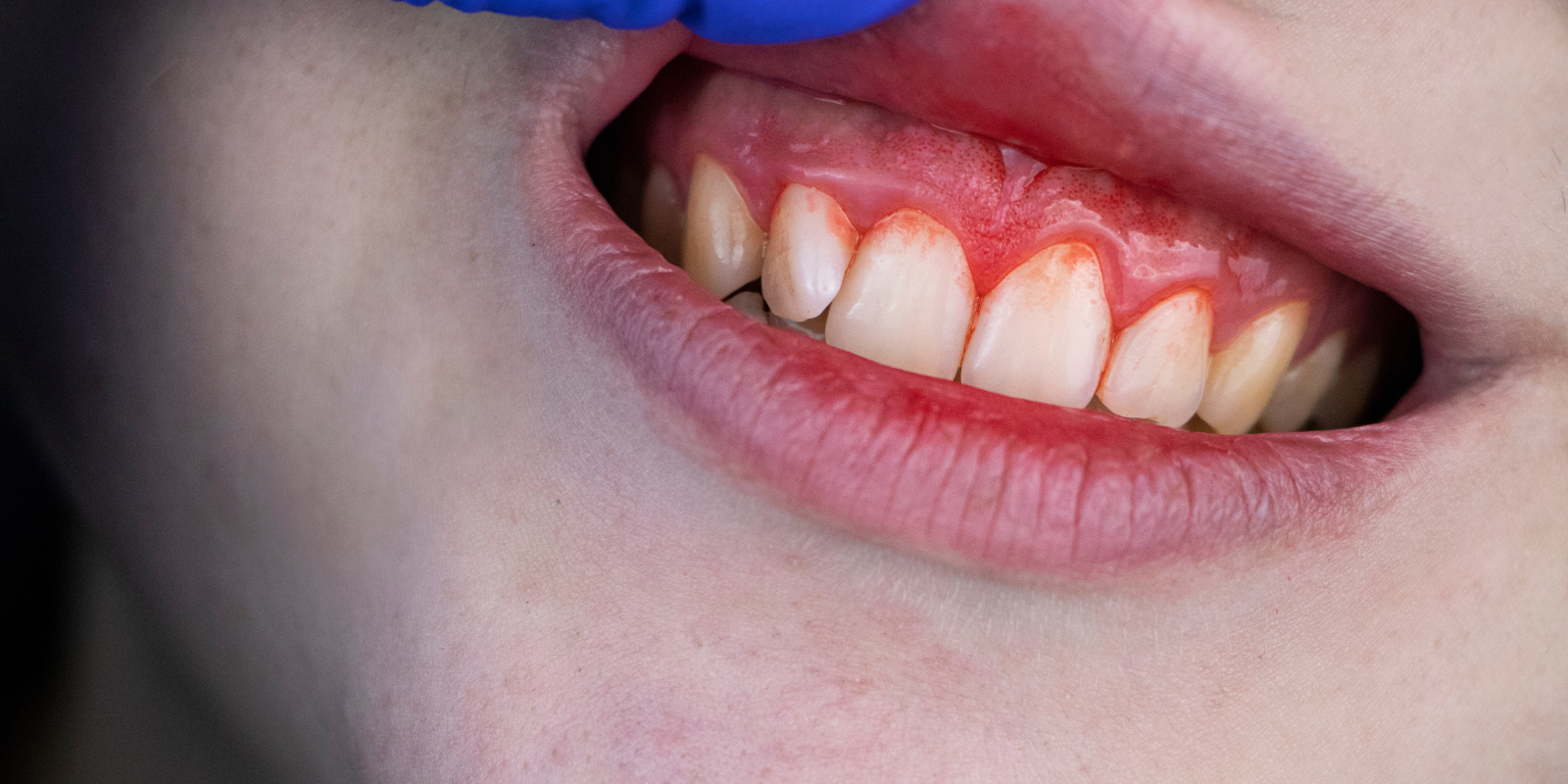 кровоточивість ясен