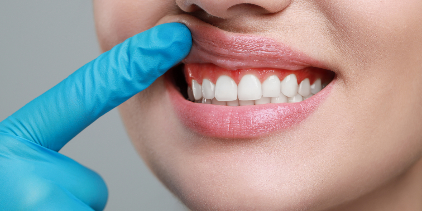 запалення ясен